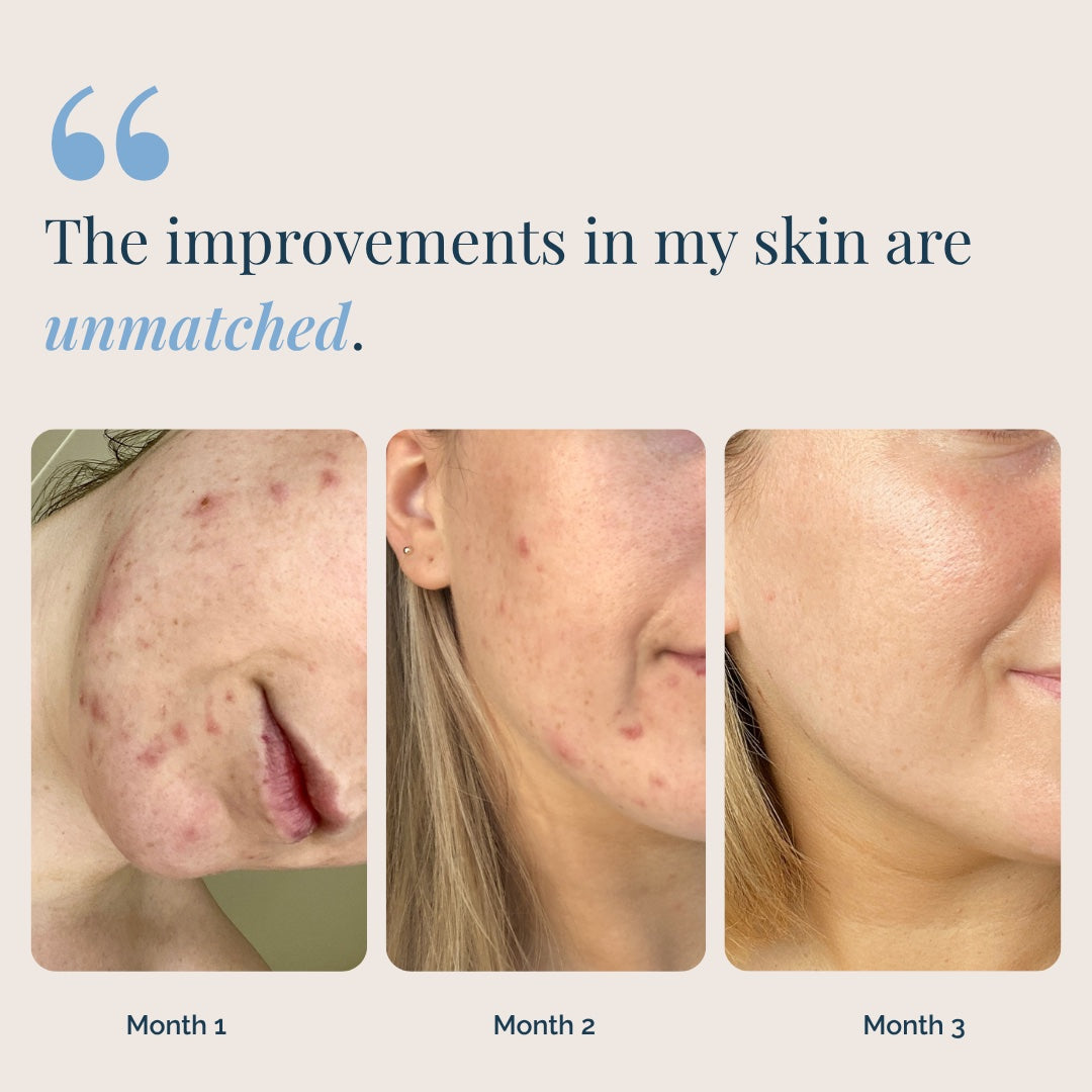Three-month skin progress photos showing visible improvement while using Gigi PMS & Hormone Balance Blend